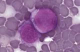 New therapeutic avenue discovered to fight against leukaemia