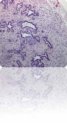 Se describe un nuevo mecanismo molecular que participa en la proliferación e invasión celular del cáncer de páncreas